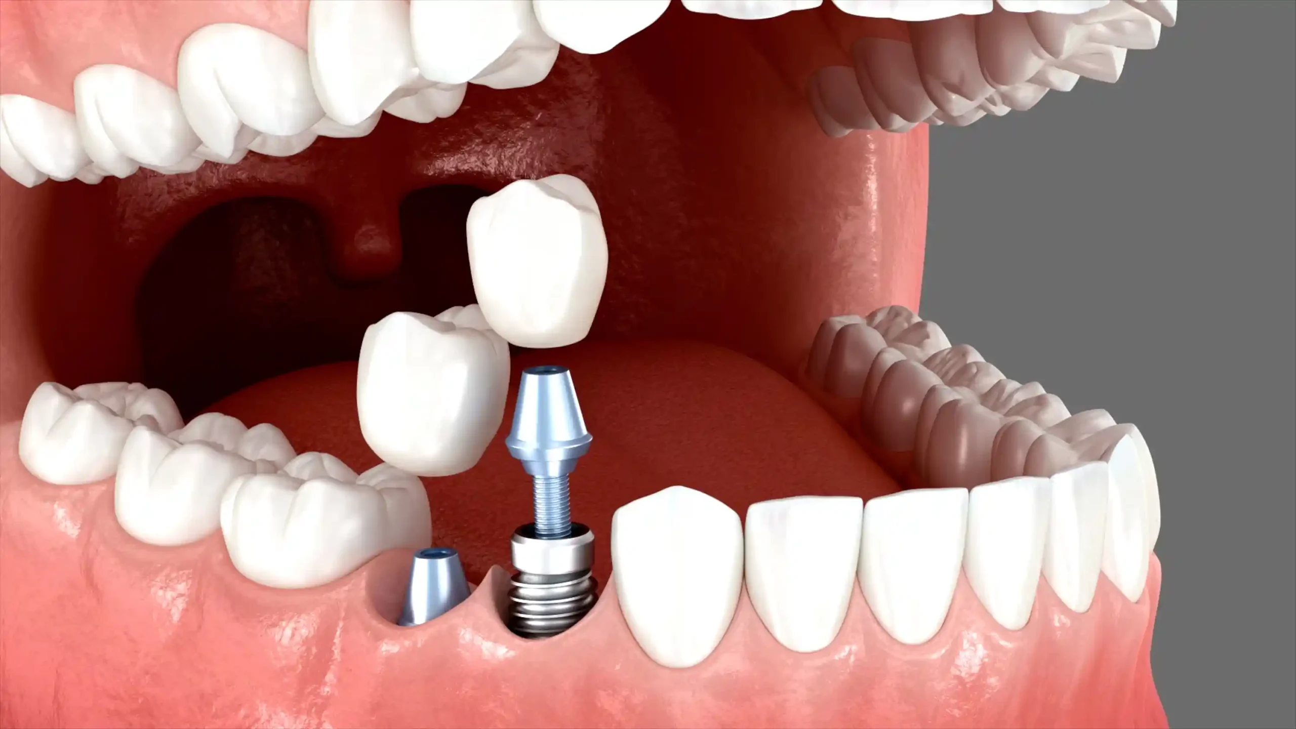 11-2025- Implantát - FAQ - HD 1 small