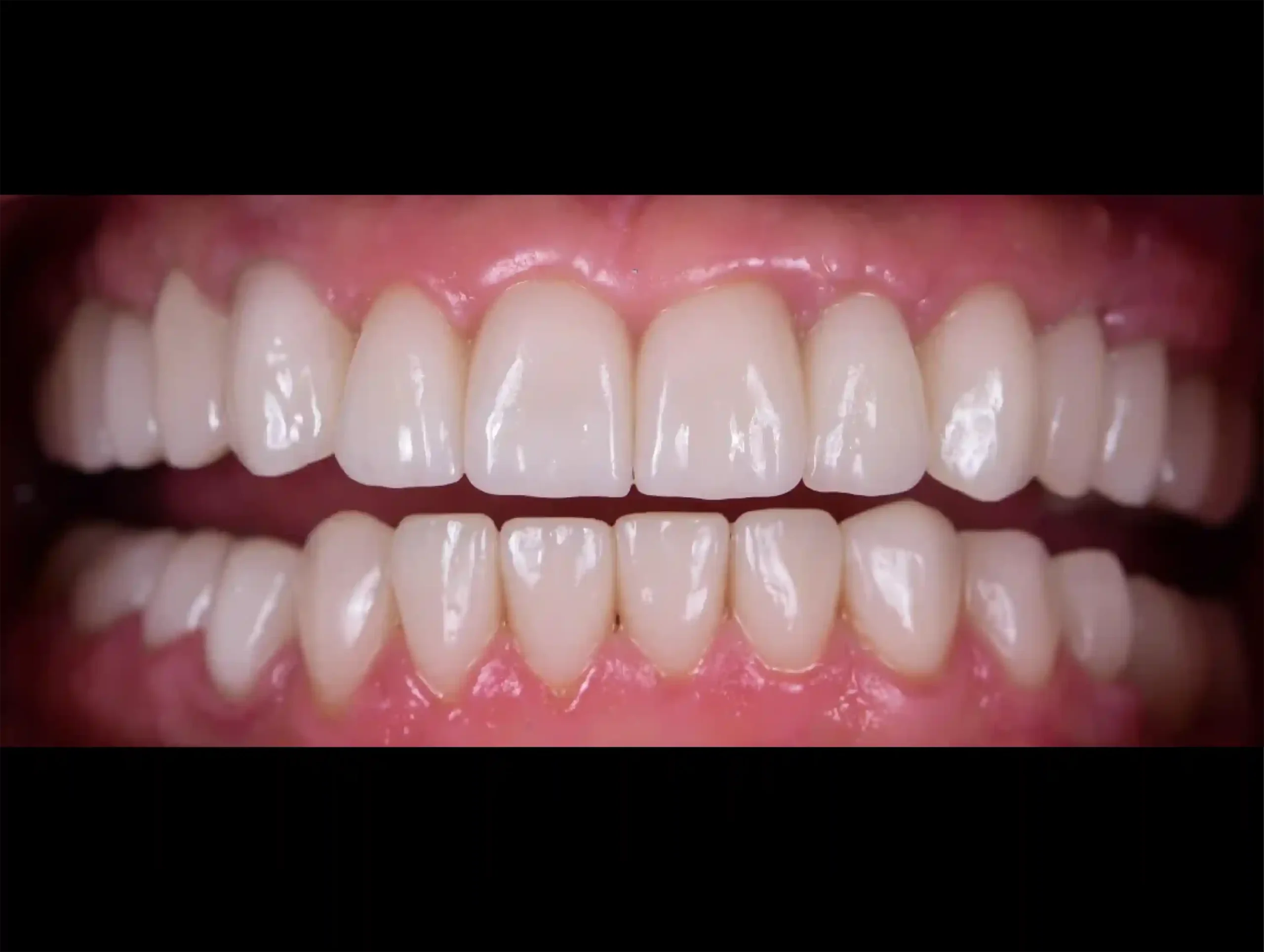 DENTICON_pred a po_Implantáty_po-1