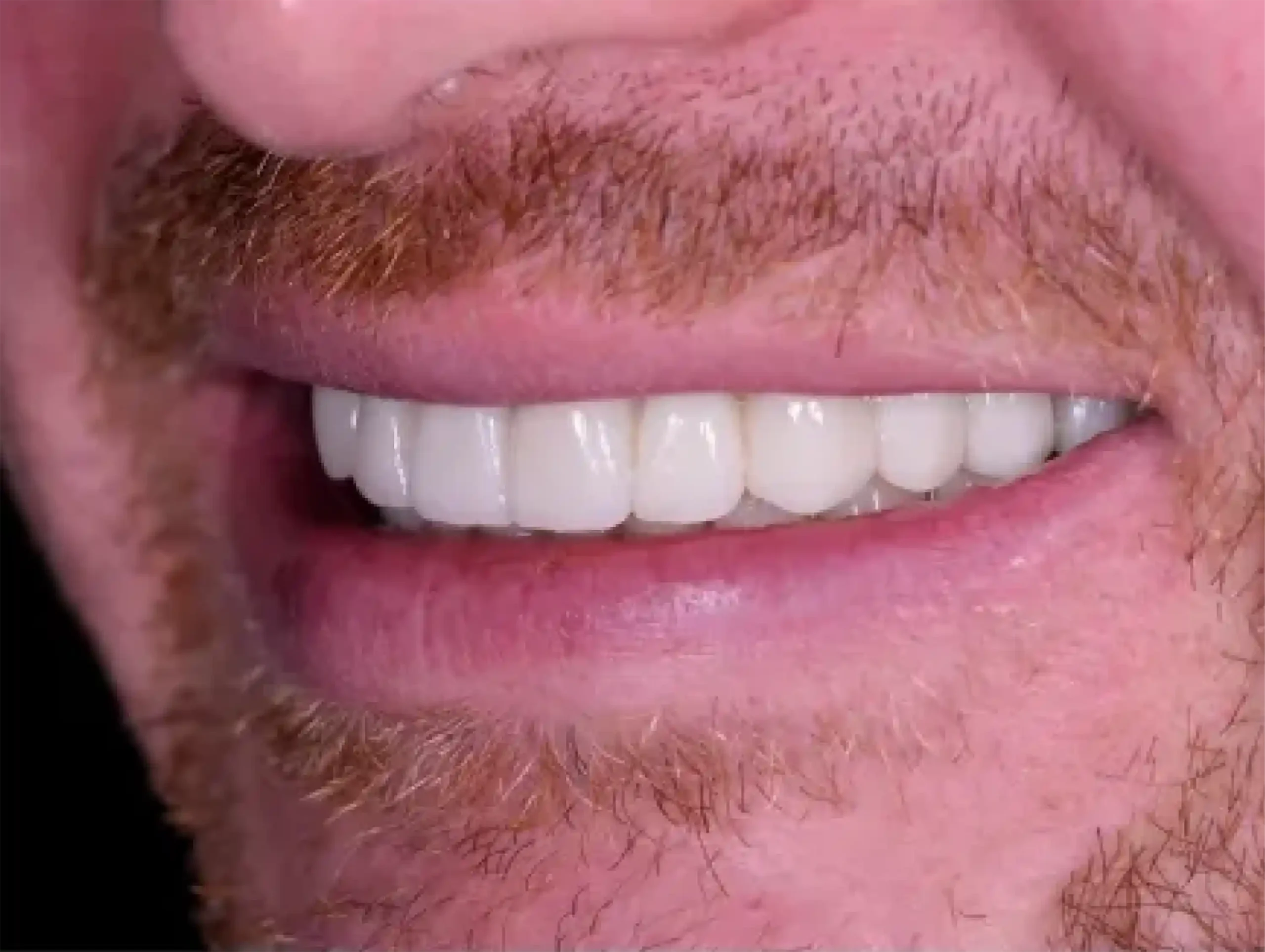 DENTICON_pred a po_Implantáty_po-2