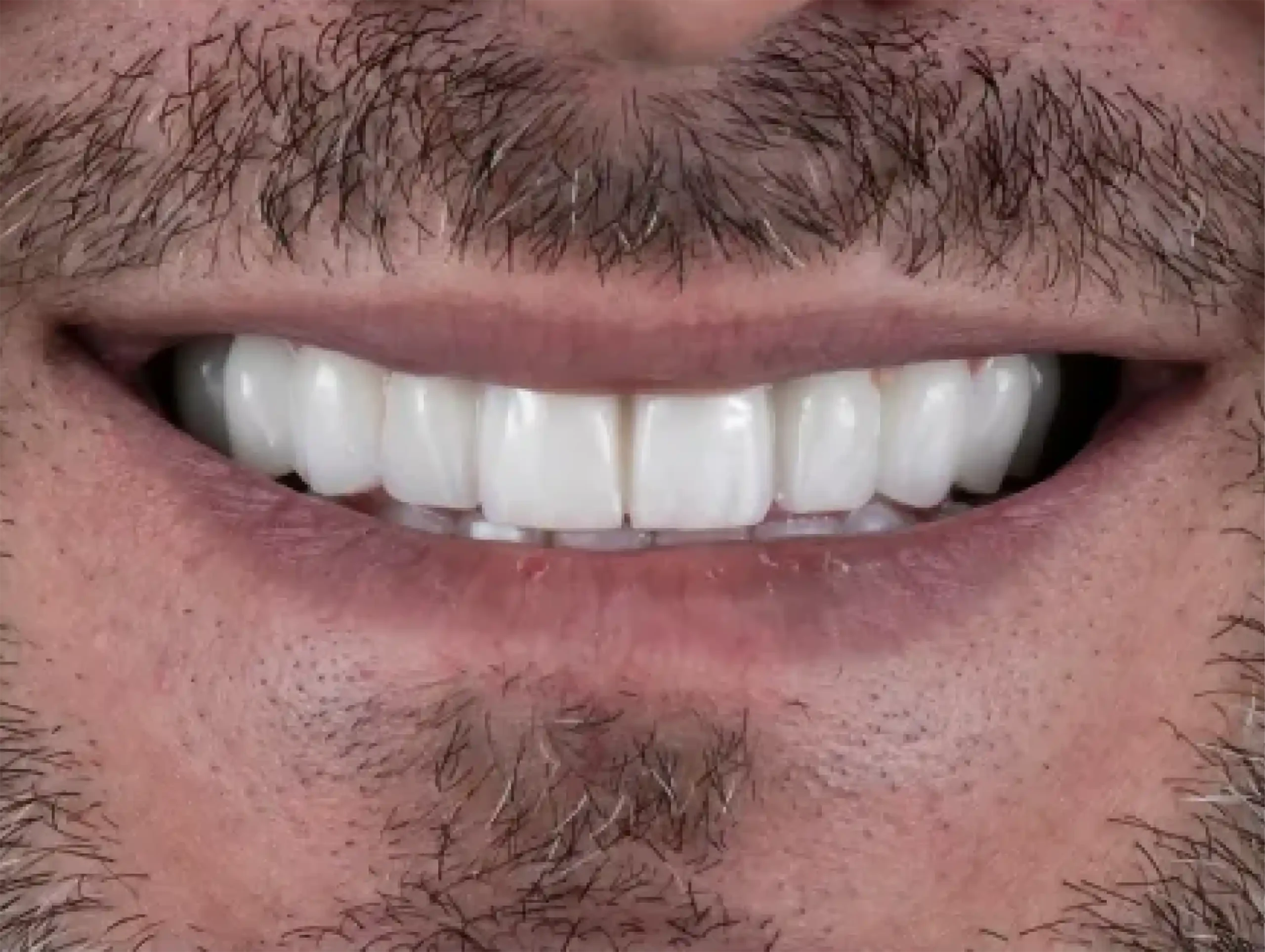 DENTICON_pred a po_Implantáty_po-3