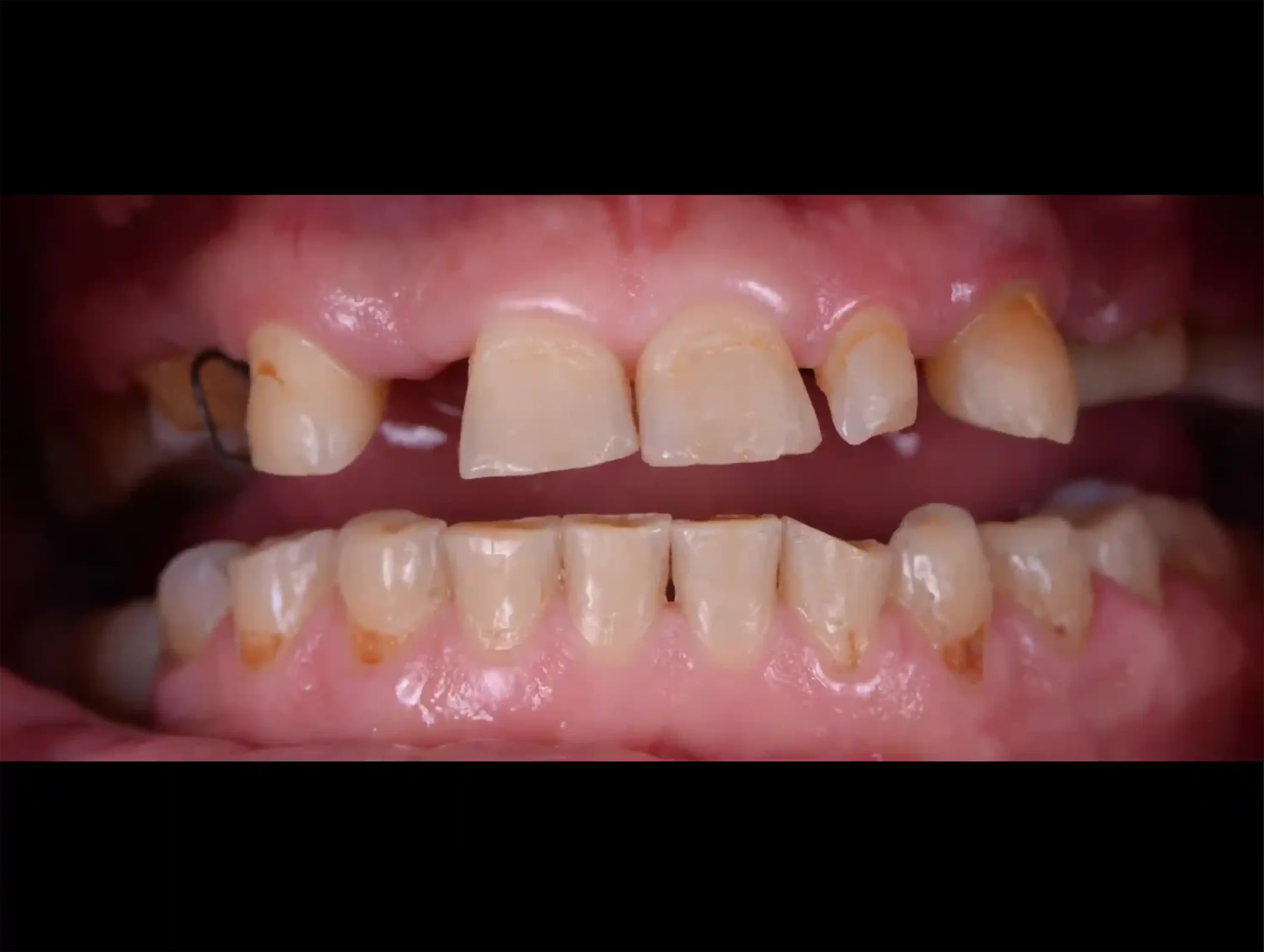 DENTICON_pred a po_Implantáty_pred-1