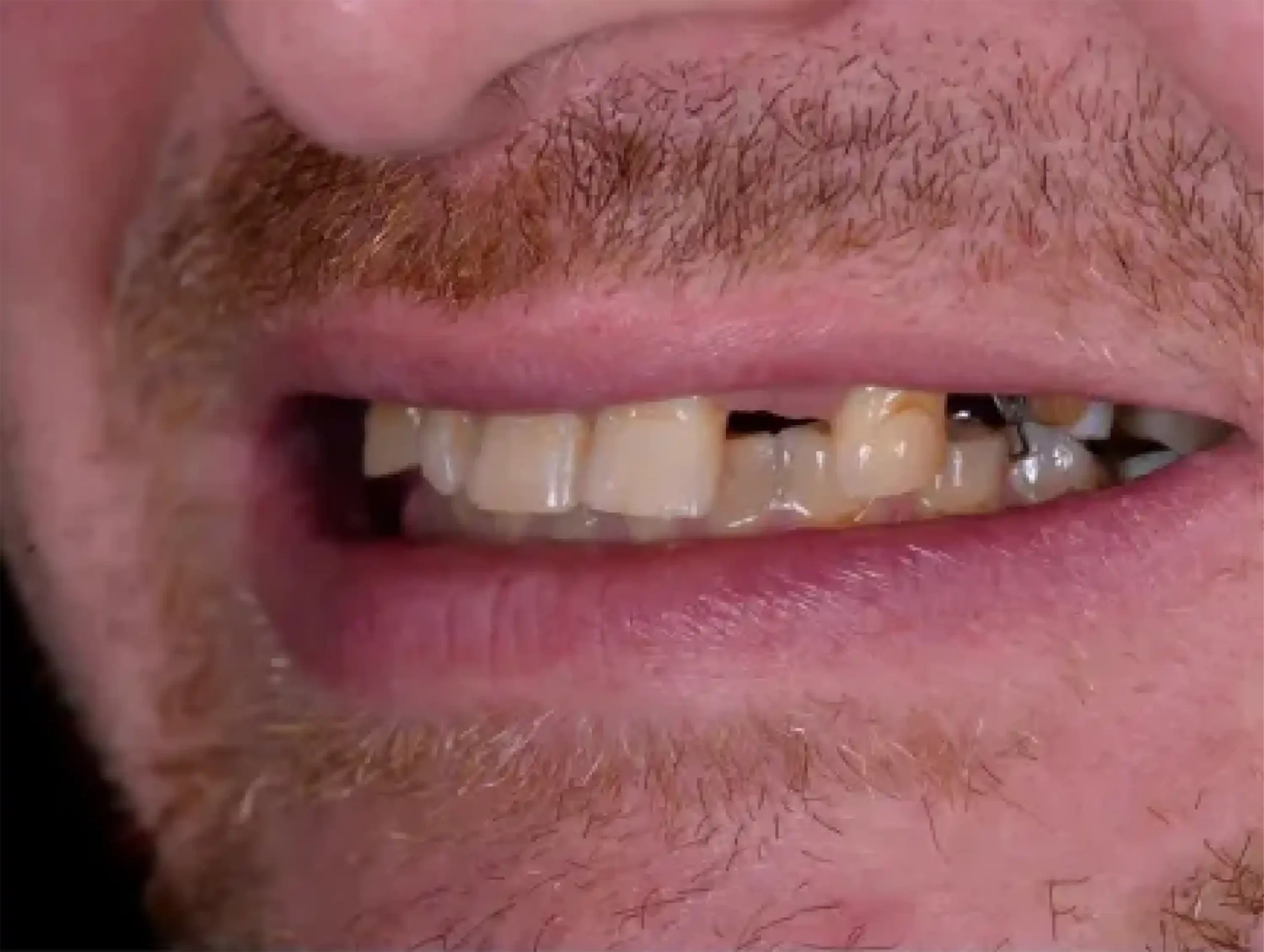 DENTICON_pred a po_Implantáty_pred-2