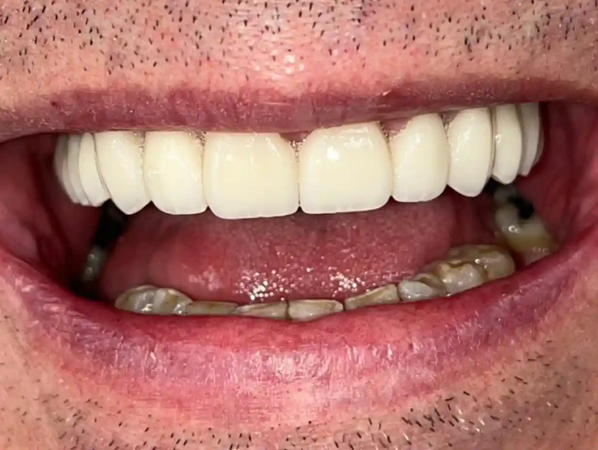 DENTICON_pred a po_Pacient 11 - Krescanko - Mostik - Po