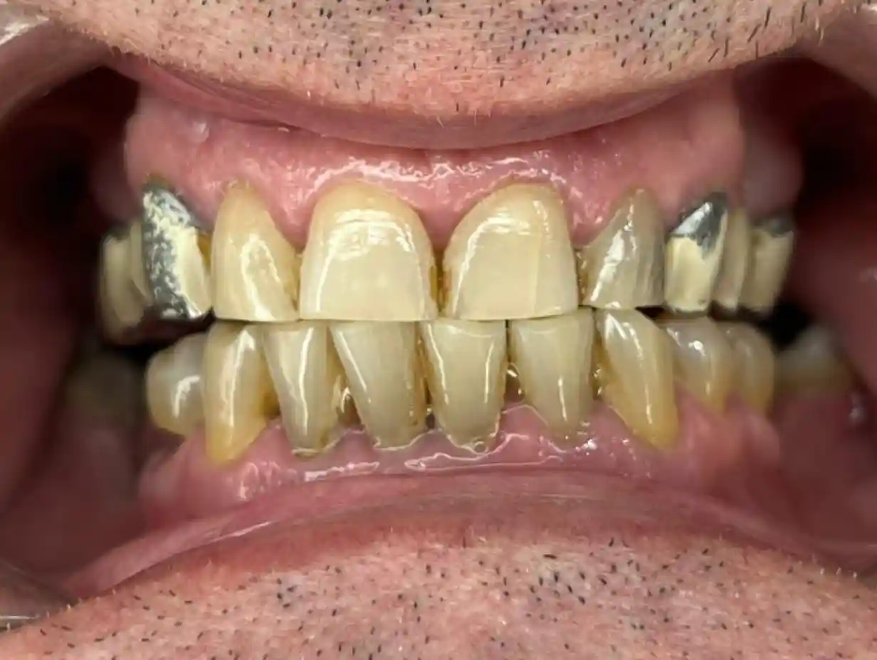 DENTICON_pred a po_Pacient 11 - Krescanko - Mostik - Pred